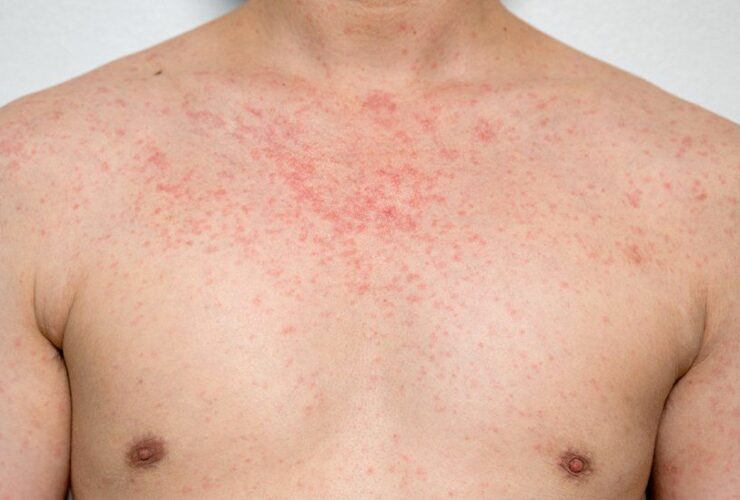 Representation for rashes caused by measles | Credits: Getty Images