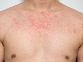 Rashes caused by Measles | Credits: Getty Images