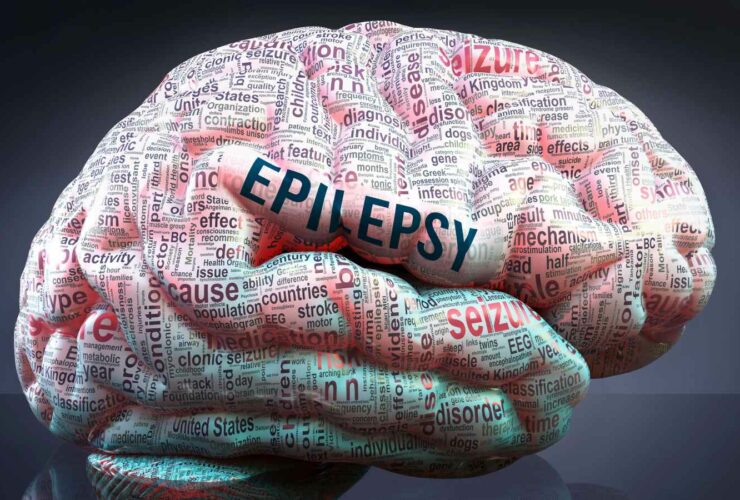 New Brain Surgery for Epilepsy Reduces Seizures